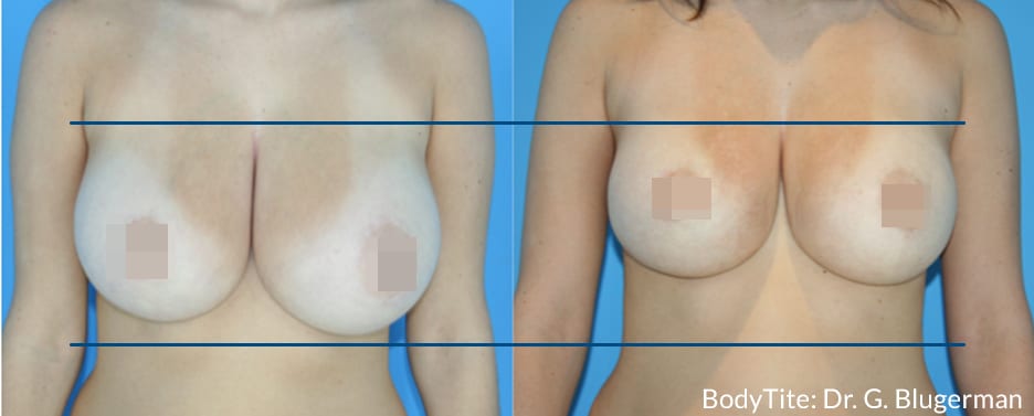 BodyTite_GB_DS_Breast1 (1)-img-blog