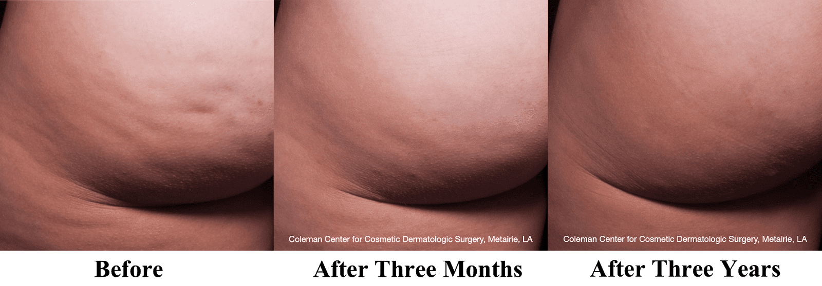 cellfina before and after pictures-img-blog