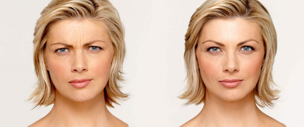 Before and after, Image courtesy of BOTOX® Cosmetic