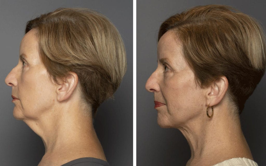 Facial Rejuvenation Patient Before & After