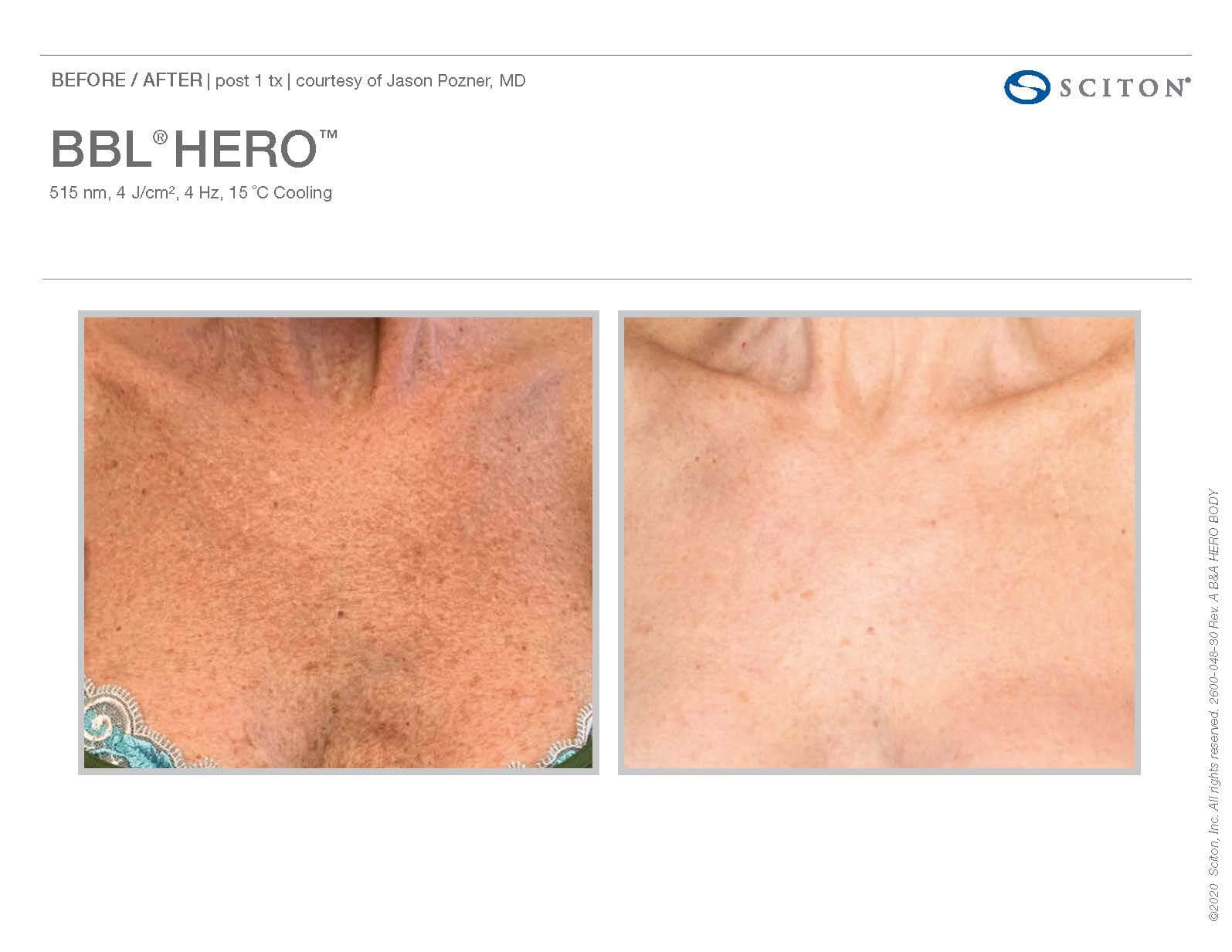 Before and after BBL Hero on Chest