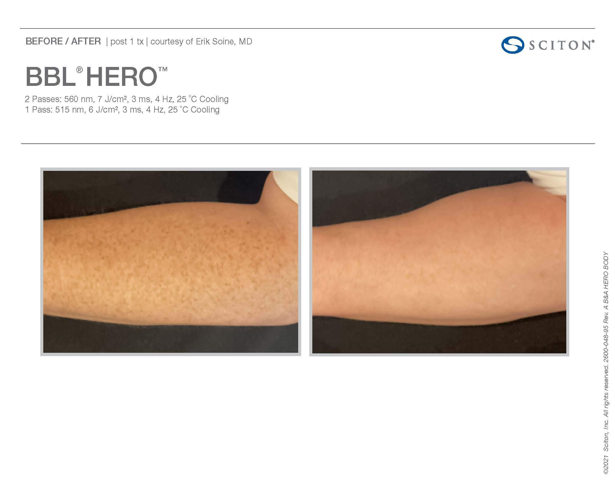 Before and after BBL Hero on calf