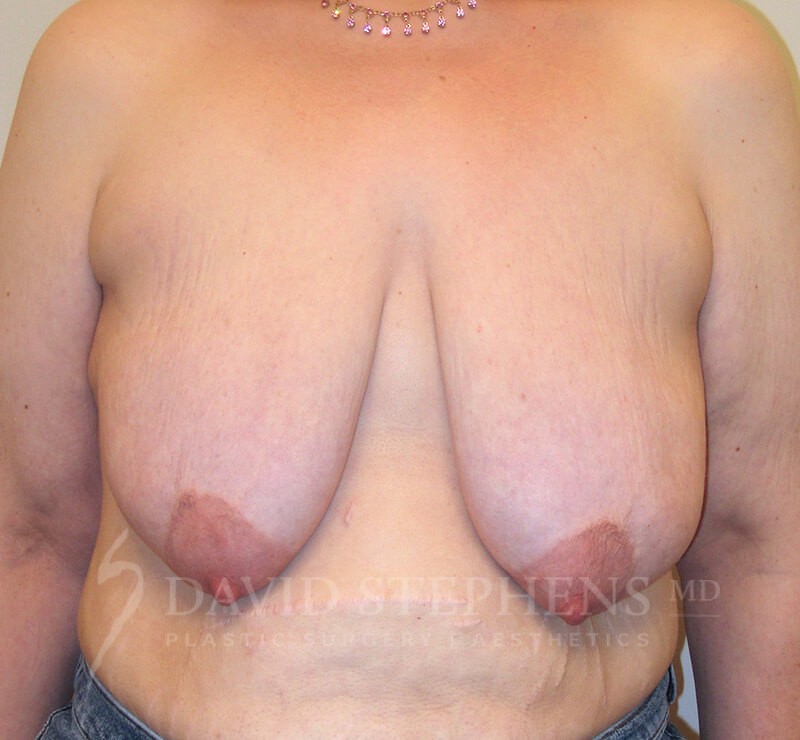 Breast-Lift-Patient-03 | Before Breast