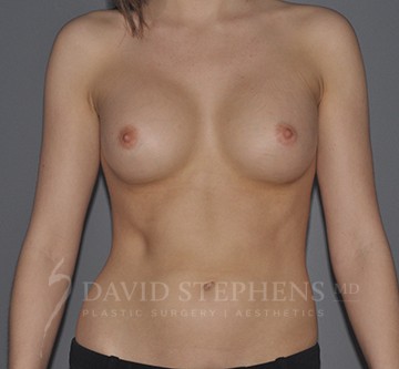 Breast-Augmentation-Patient-60 | After Breast