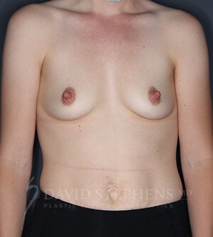 Breast-Augmentation-Patient-59 | Before Breast
