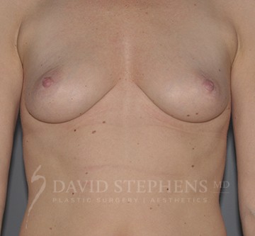 Breast-Augmentation-Patient-53 | Before Breast