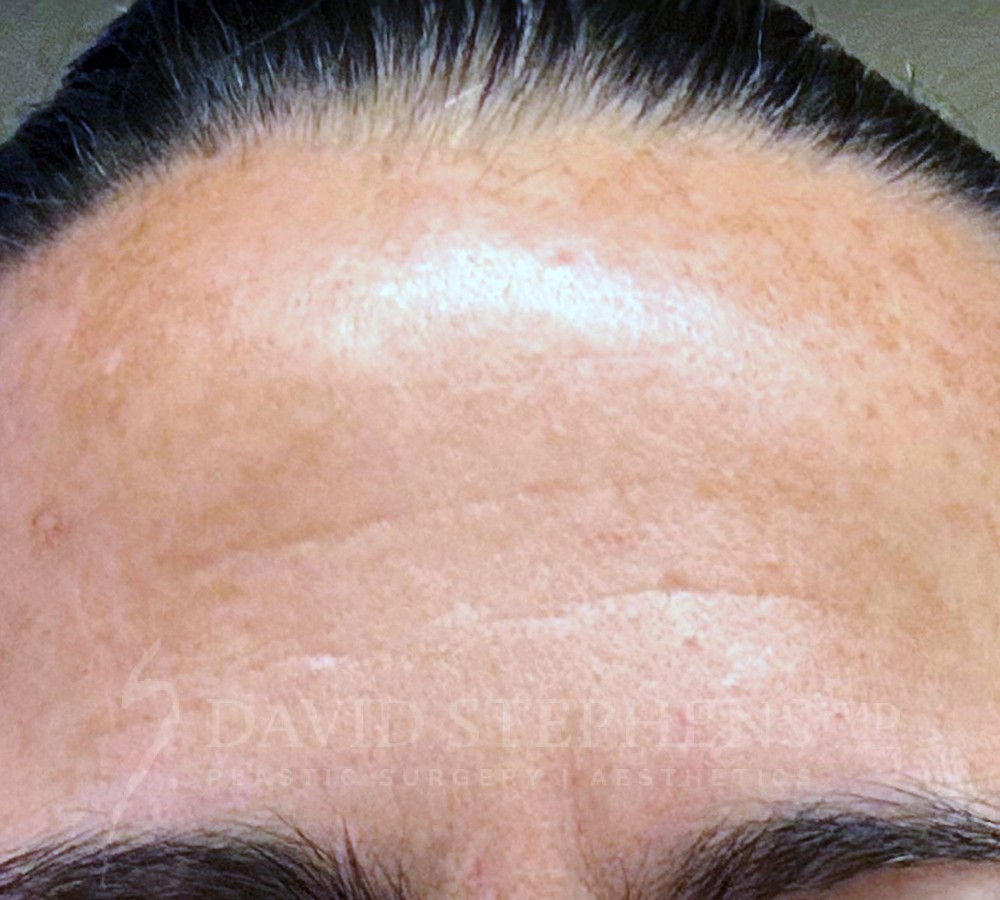 Patient's forehead After Moxi treatment
