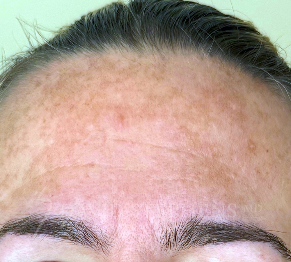 Patient's forehead Before Moxi treatment